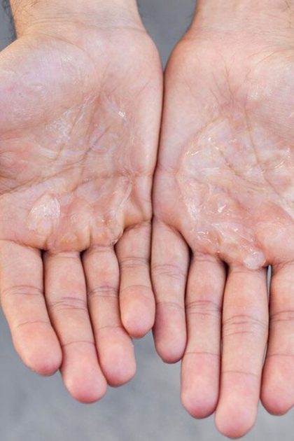Hyperhidrosis, from the lecture slides