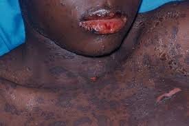Stevens-Johnson syndrome, from the lecture slides