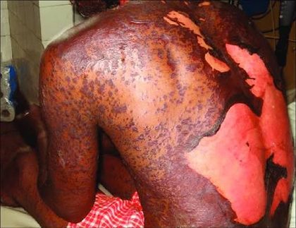 Toxic epidermal necrolysis, from the lecture slides