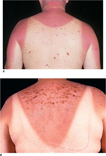 Sunburn, from the lecture slides