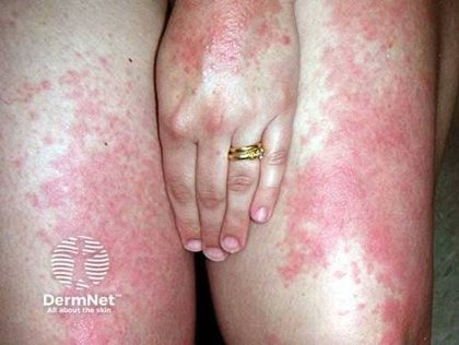 Polymorphous light eruption, from the lecture slides