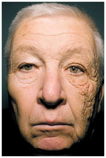 Dermatoheliosis (photoaging), from the lecture slides