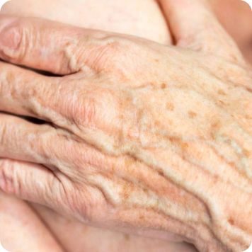 Actinic keratosis, from the lecture slides