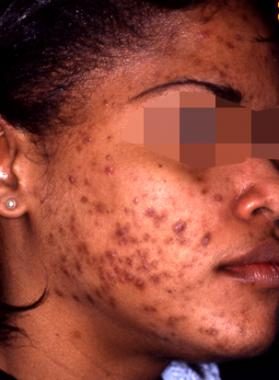 Acne vulgaris, from the lecture slides