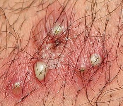 Folliculitis, from the lecture slides