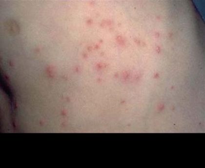 Pseudomonas (&ldquo;hot tub&rdquo;) folliculitis, from the lecture slides