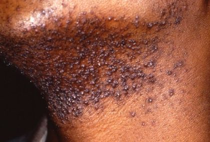 Pseudofolliculitis barbae, from the lecture slides