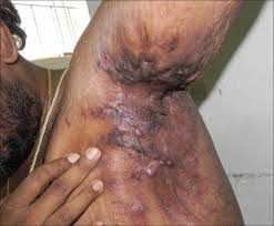 Hidradenitis suppurativa, from the lecture slides