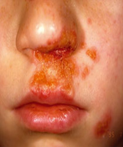 Impetigo - non-bullous, from the lecture slides