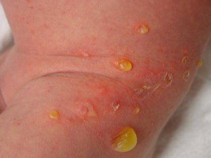 Impetigo - bullous, from the lecture slides