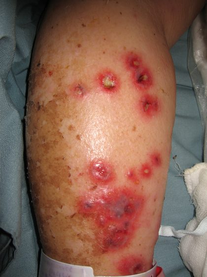 Ecthyma, from the lecture slides