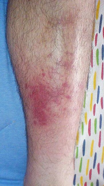 Cellulitis, from the lecture slides