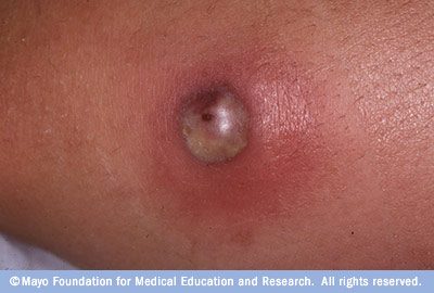 Abscess, from the lecture slides