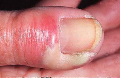 Acute paronychia, from the lecture slides