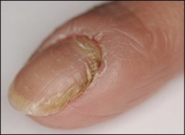 Chronic paronychia &mdash; Retracted cuticle and nail dystrophy over months