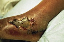 Necrotizing fasciitis, from the lecture slides