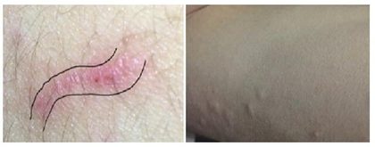 Scabies, from the lecture slides