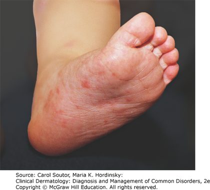 Crusted (hyperkeratotic) scabies, from the lecture slides