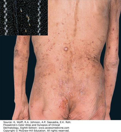 Pediculosis corporis (body lice), from the lecture slides