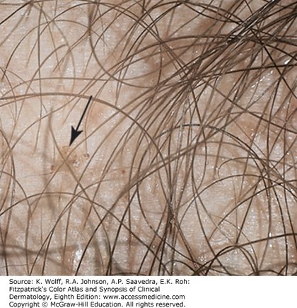 Pediculosis capitis (head lice), from the lecture slides