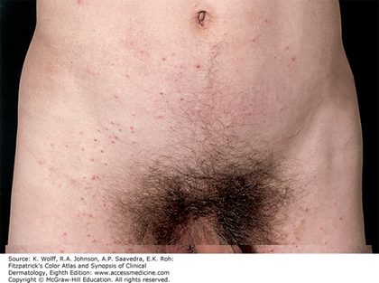Pediculosis pubis (crabs), from the lecture slides