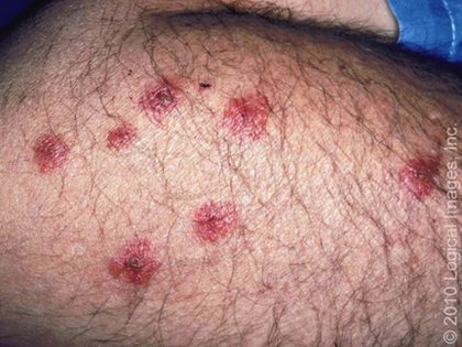 Bedbugs, from the lecture slides