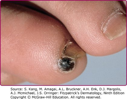 Tungiasis (fleas), from the lecture slides