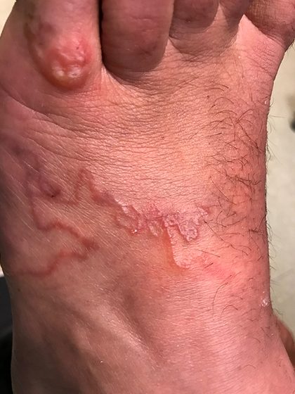 Cutaneous larva migrans, from the lecture slides