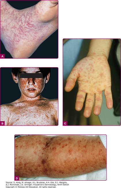 Rocky Mountain spotted fever, from the lecture slides