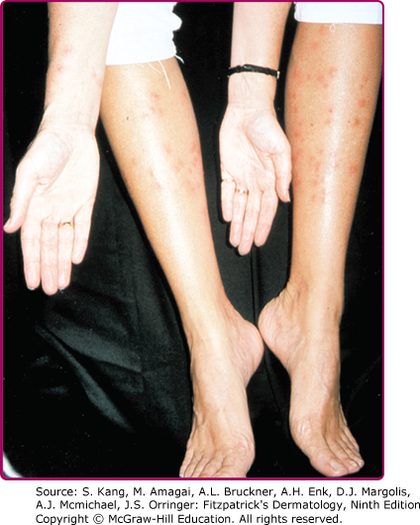 Cercarial dermatitis (swimmer's itch), from the lecture slides