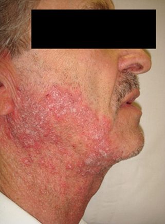 Tinea barbae - noninflammatory, from the lecture slides