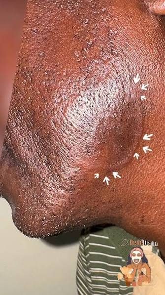 Tinea barbae - inflammatory, from the lecture slides