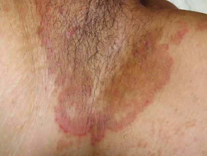 Tinea cruris (groin) - &ldquo;jock itch&rdquo;, from the lecture slides
