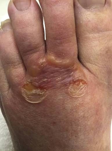 Tinea pedis - interdigital, from the lecture slides