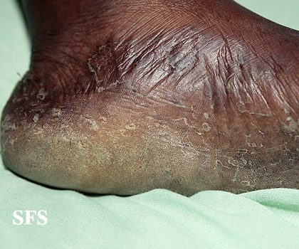 Tinea pedis - hyperkeratotic, from the lecture slides