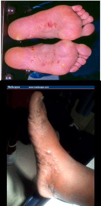 Tinea pedis - vesiculobullous, from the lecture slides