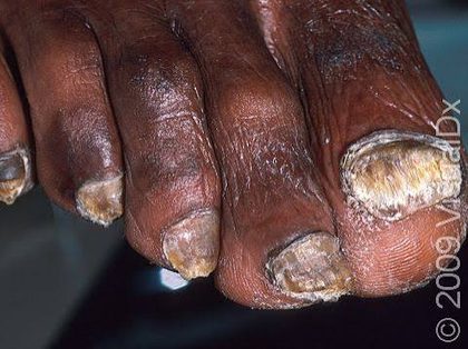 Onychomycosis (tinea unguium), from the lecture slides