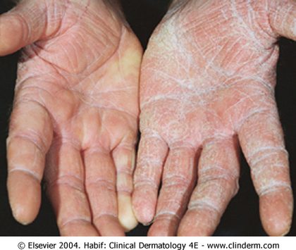 Tinea manuum (hand), from the lecture slides