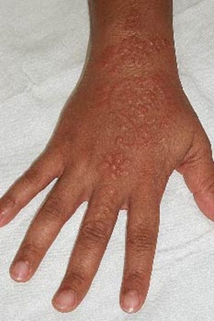 Id (dermatophytid) reaction, from the lecture slides