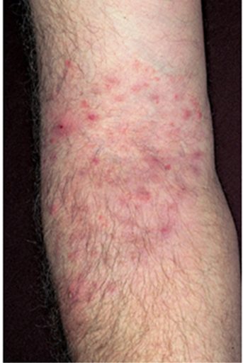 Tinea incognito, from the lecture slides