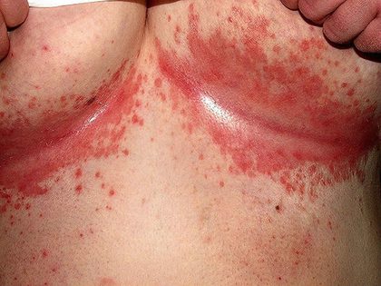 Cutaneous candidiasis and intertrigo, from the lecture slides