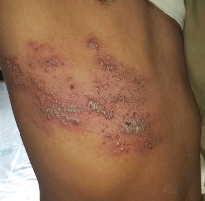 Herpes zoster (shingles), from the lecture slides