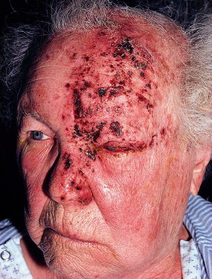 Herpes zoster ophthalmicus, from the lecture slides