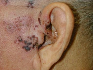Ramsay Hunt syndrome (herpes zoster oticus), from the lecture slides
