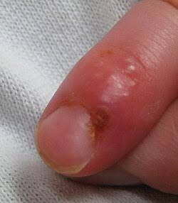 Herpetic whitlow, from the lecture slides