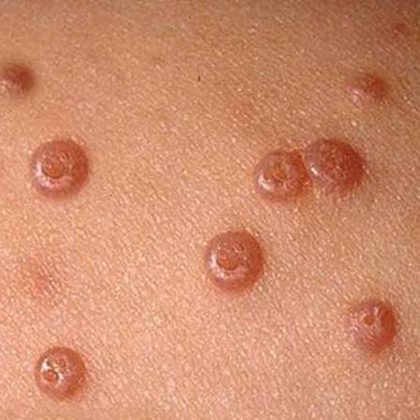 Molluscum contagiosum, from the lecture slides