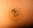 Verruca vulgaris (common warts), from the lecture slides