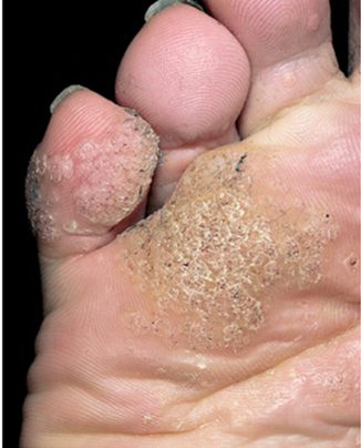 Verruca plantaris (plantar warts), from the lecture slides