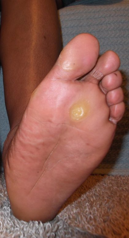 Callus, from the lecture slides