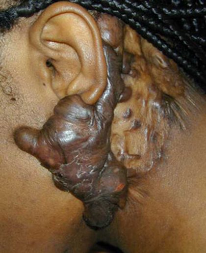 Keloid, from the lecture slides